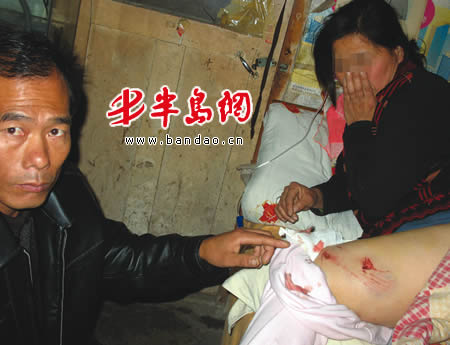 时<em>女士</em>的腿被咬出两个洞
